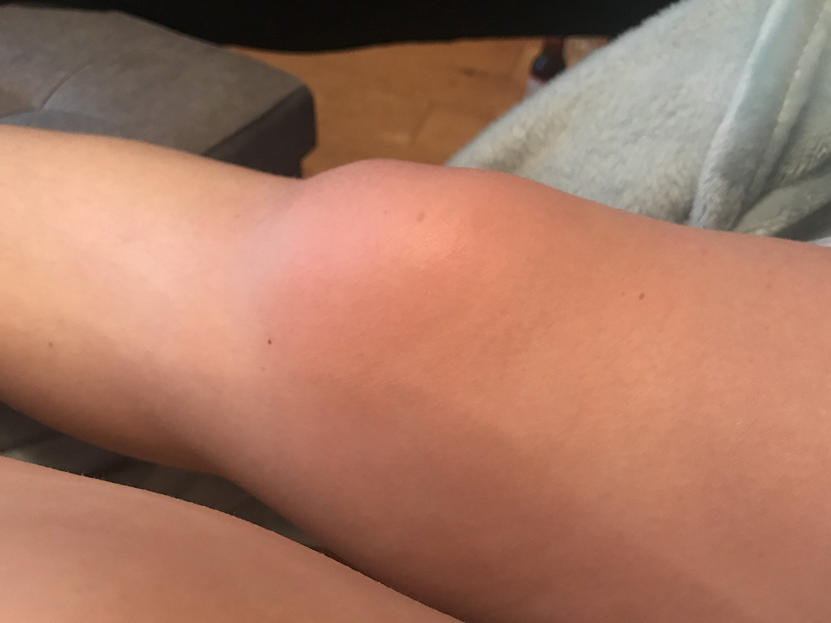 Paige-Joanna-Arthritis-knee